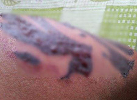 痂皮是由什么组成的？