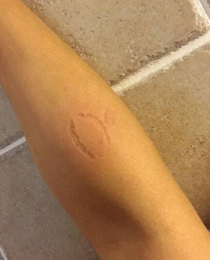 被人用牙齿咬痕图片和吻痕的区别