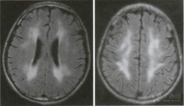 线粒体脑肌病的临床表现