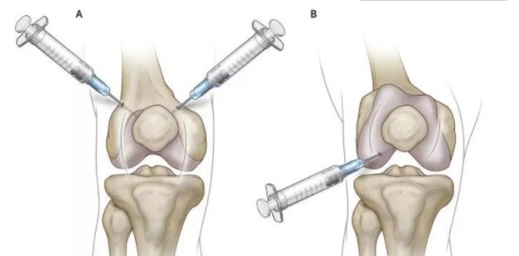 神经阻滞疗法和“打封闭”有何区别？