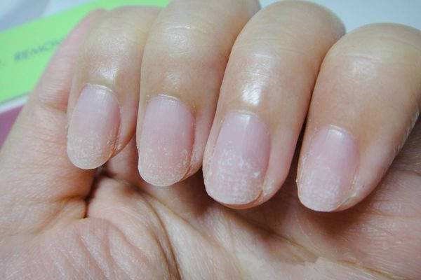 指甲凹凸不平，不要慌，原因一般有哪几个？