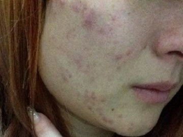 毛囊炎该怎么治疗？