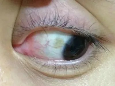 家族性进行性色素沉着症斑图片