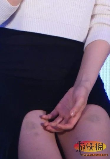 高圆圆大腿淤青 赵又廷人面兽心施家暴?救女神