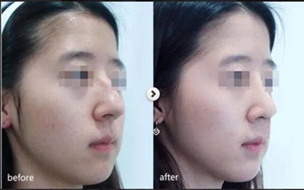 北京做玻尿酸隆鼻到哪个医院好