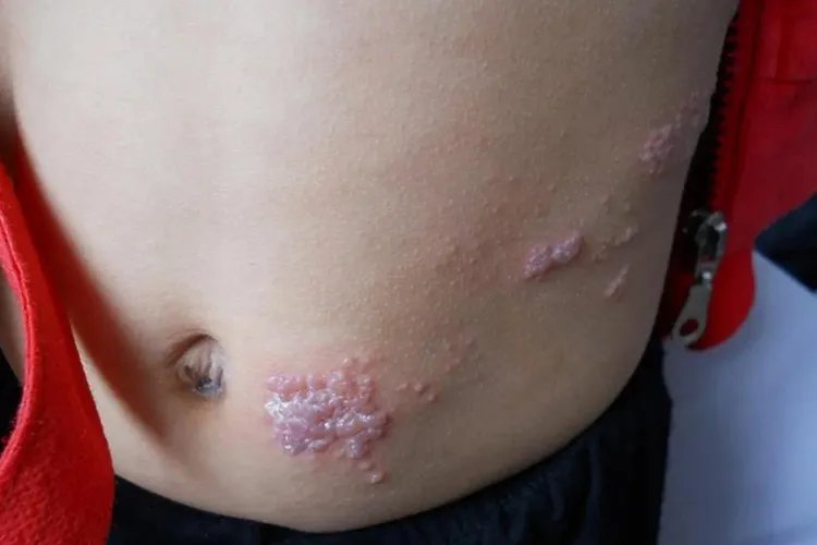 儿童蛇胆疮图片大全