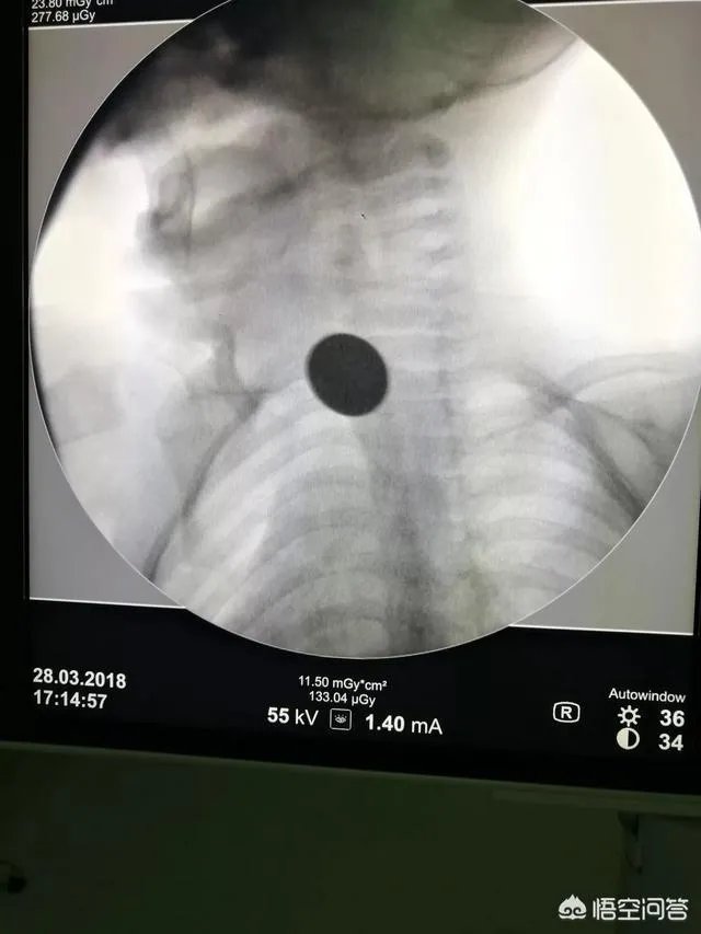 作为医生，你们见过的最幸运的病人有多幸运？