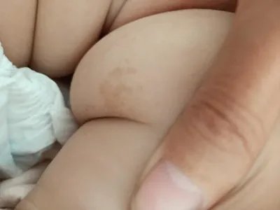 咖啡斑症状图片