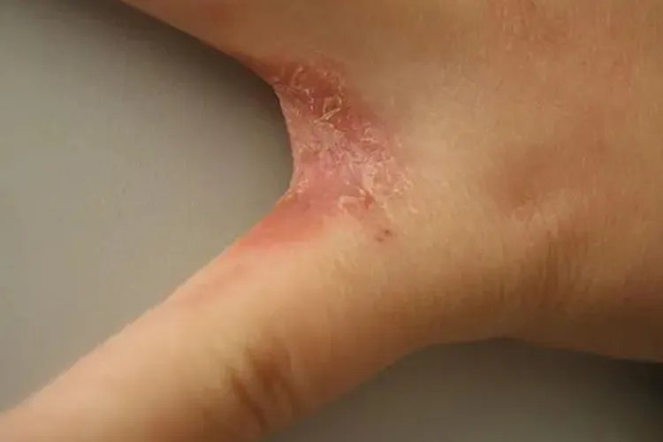 手癣图片初期症状图片大全