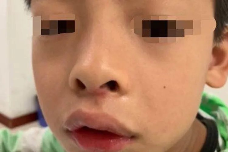 6岁娃腺样体肥大面容照片