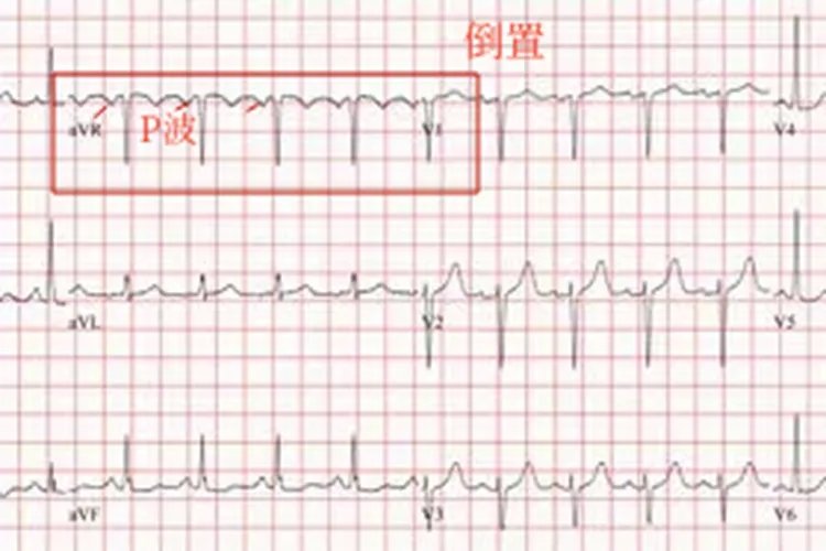 10种常见异常心电图