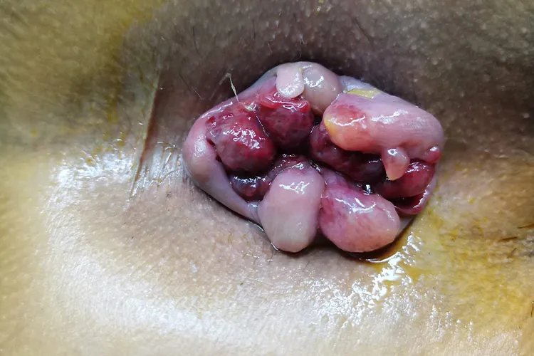 女性怎么判断自己得了痔疮图片