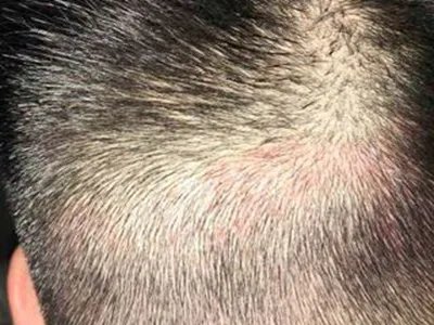 念珠状发症状图片