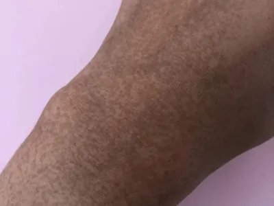 家族性进行性色素沉着症斑图片