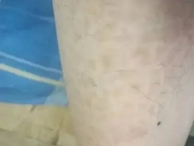 咖啡斑症状图片