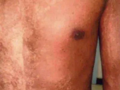 家族性进行性色素沉着症斑图片