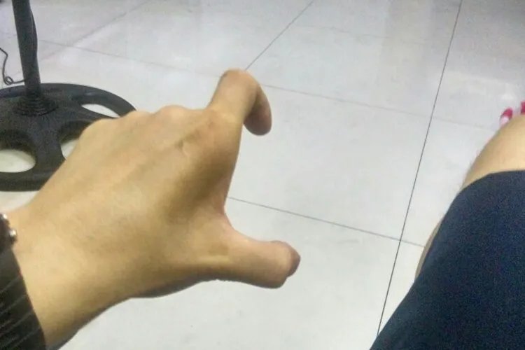 手虎口处肌肉塌陷图片