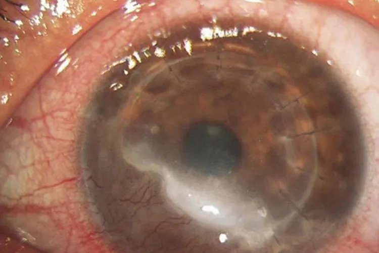 儿童角膜炎的症状图片