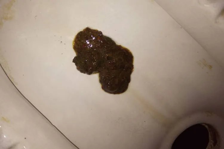 肠癌大便形状图样