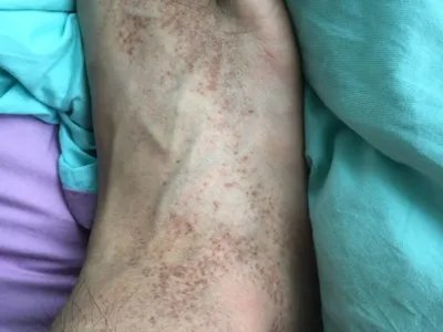 家族性进行性色素沉着症斑图片