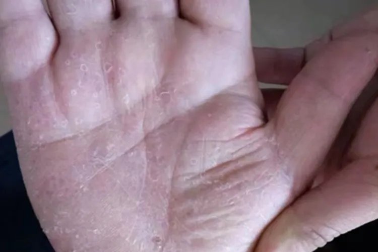 水疱型手癣症状图片