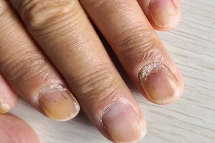 什么是灰指甲症状图片