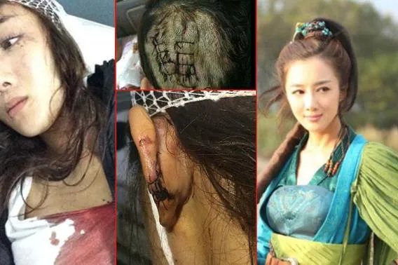 李依晓被咬事件始末以及被咬后的惨状图