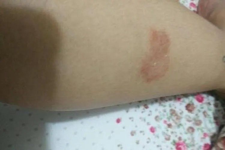 腿上长了一片红癣图片