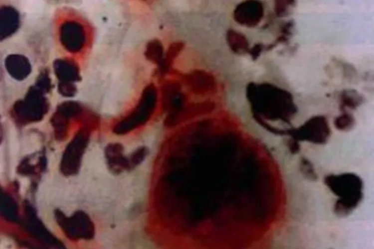 癌细胞真实图片