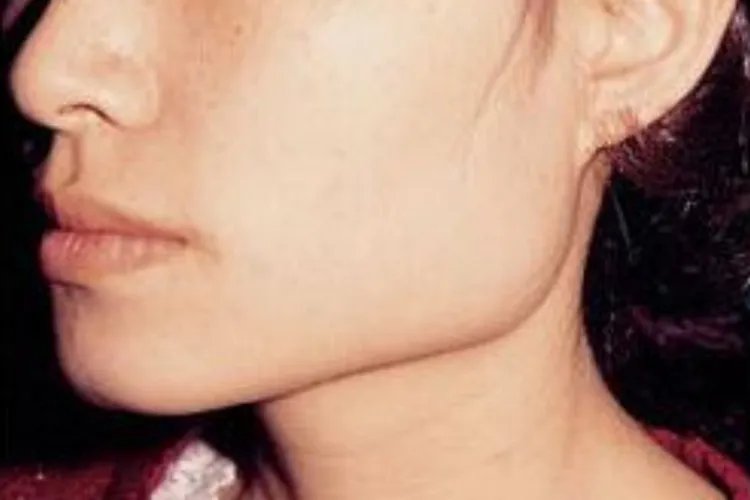 磨骨一年后对比照片