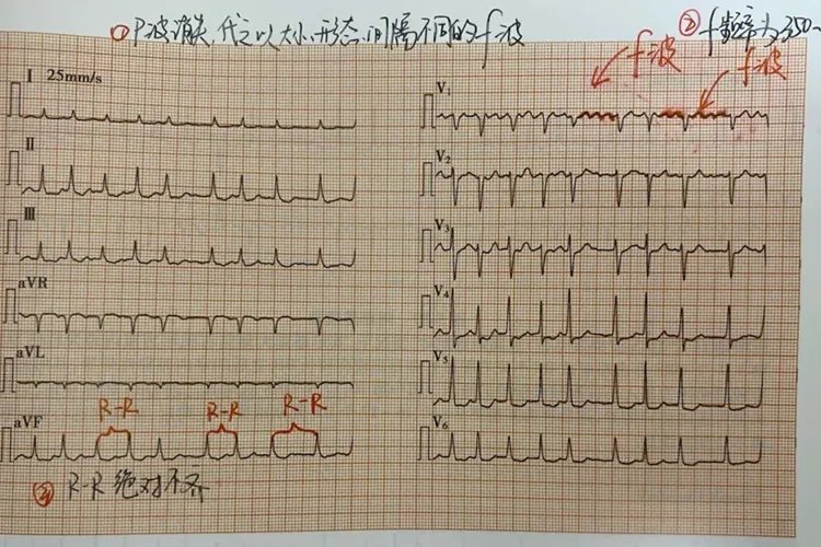 10种常见异常心电图