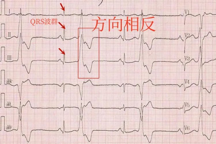 10种常见异常心电图