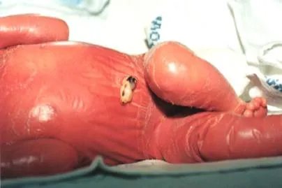 火棉胶婴儿真实图片