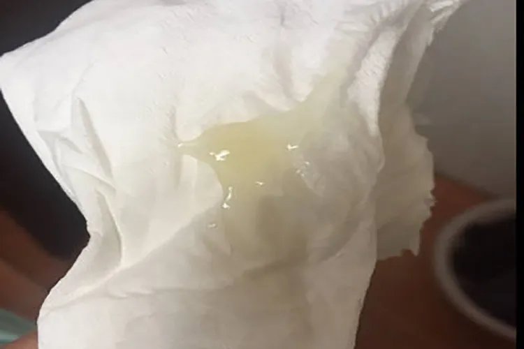 宫颈癌早期排液什么样的图片