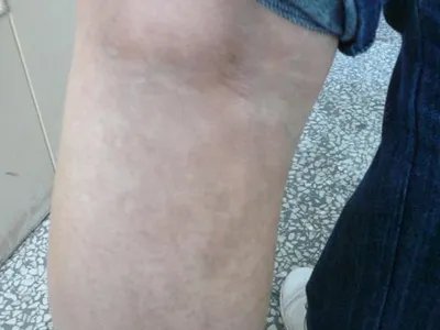 家族性进行性色素沉着症斑图片