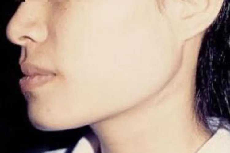 磨骨一年后对比照片