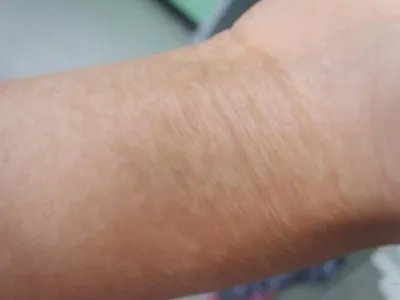 家族性进行性色素沉着症斑图片