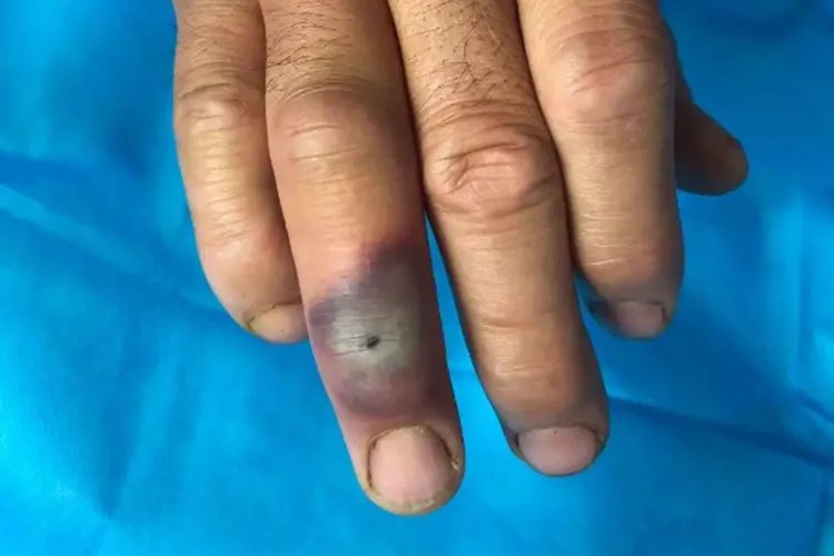 炭疽病图片及防治