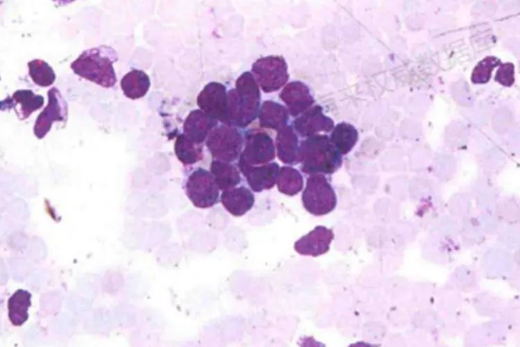 癌细胞真实图片