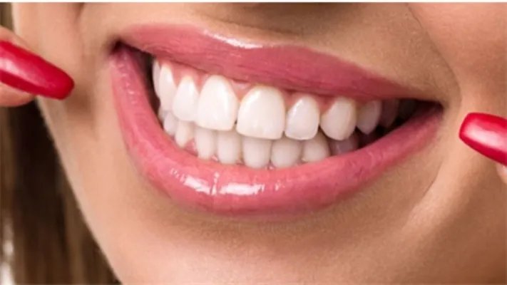 美容冠矫正牙齿多少钱一颗