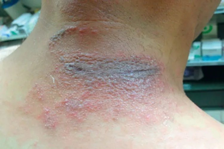 隐翅虫咬人后图片治疗方法