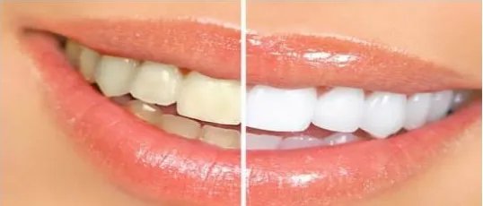 大连做牙齿美白好吗