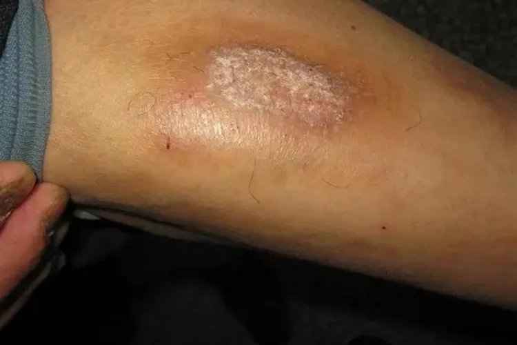 腿上长了一片红癣图片