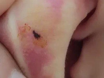 交界痣耳廓黑痣图片