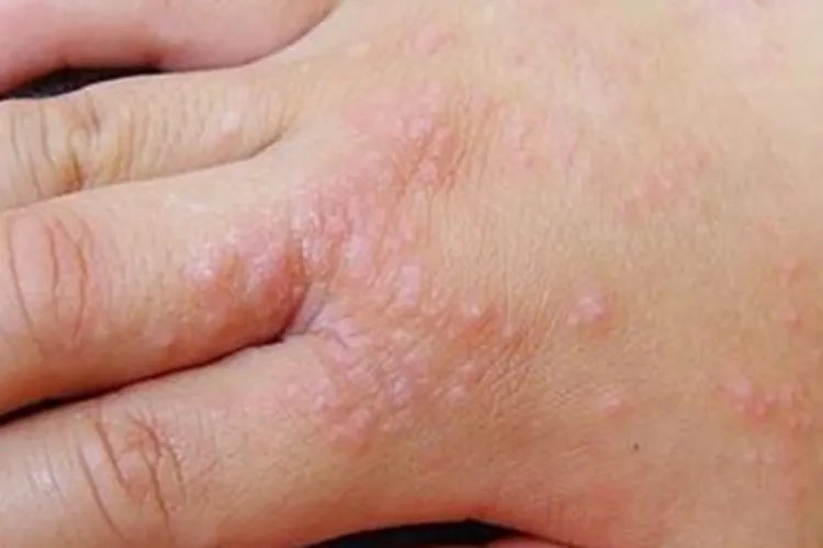 水疱型手癣症状图片