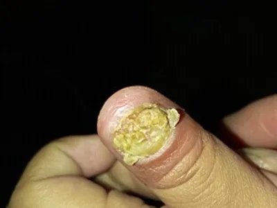 职业性指甲改变萎缩图片