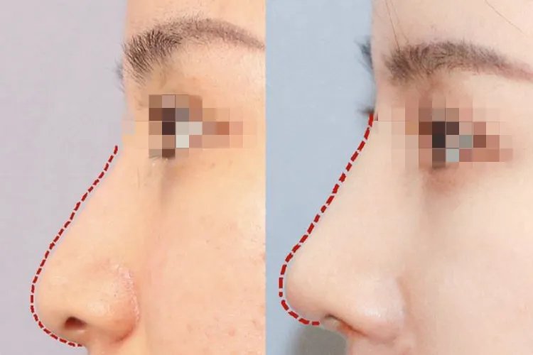 隆鼻前后对比效果图片