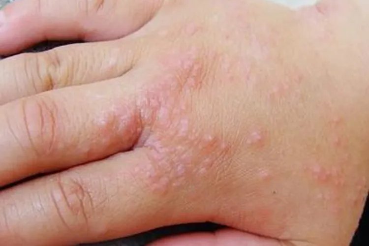 手癣图片初期症状图片大全