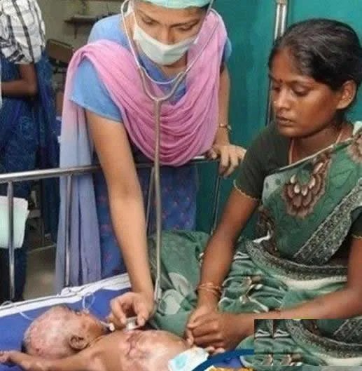 三月男婴身体无故自燃医生无解(图)