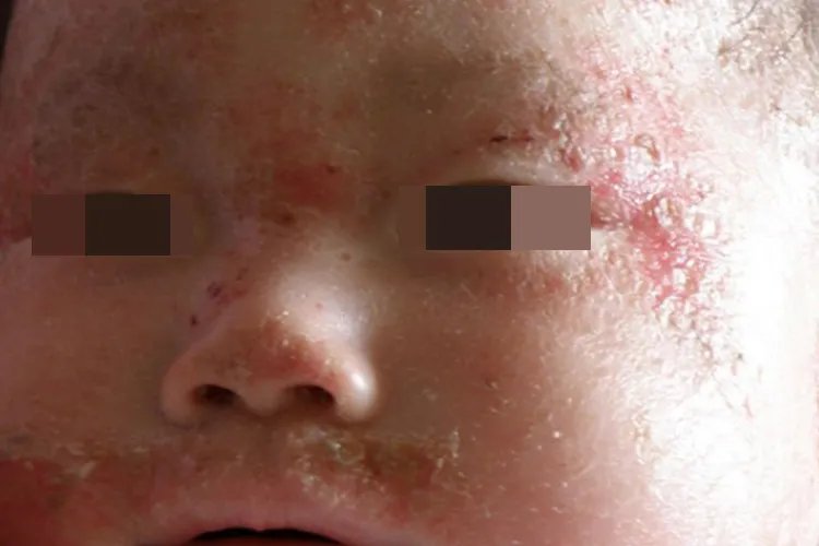 儿童蛇胆疮图片大全